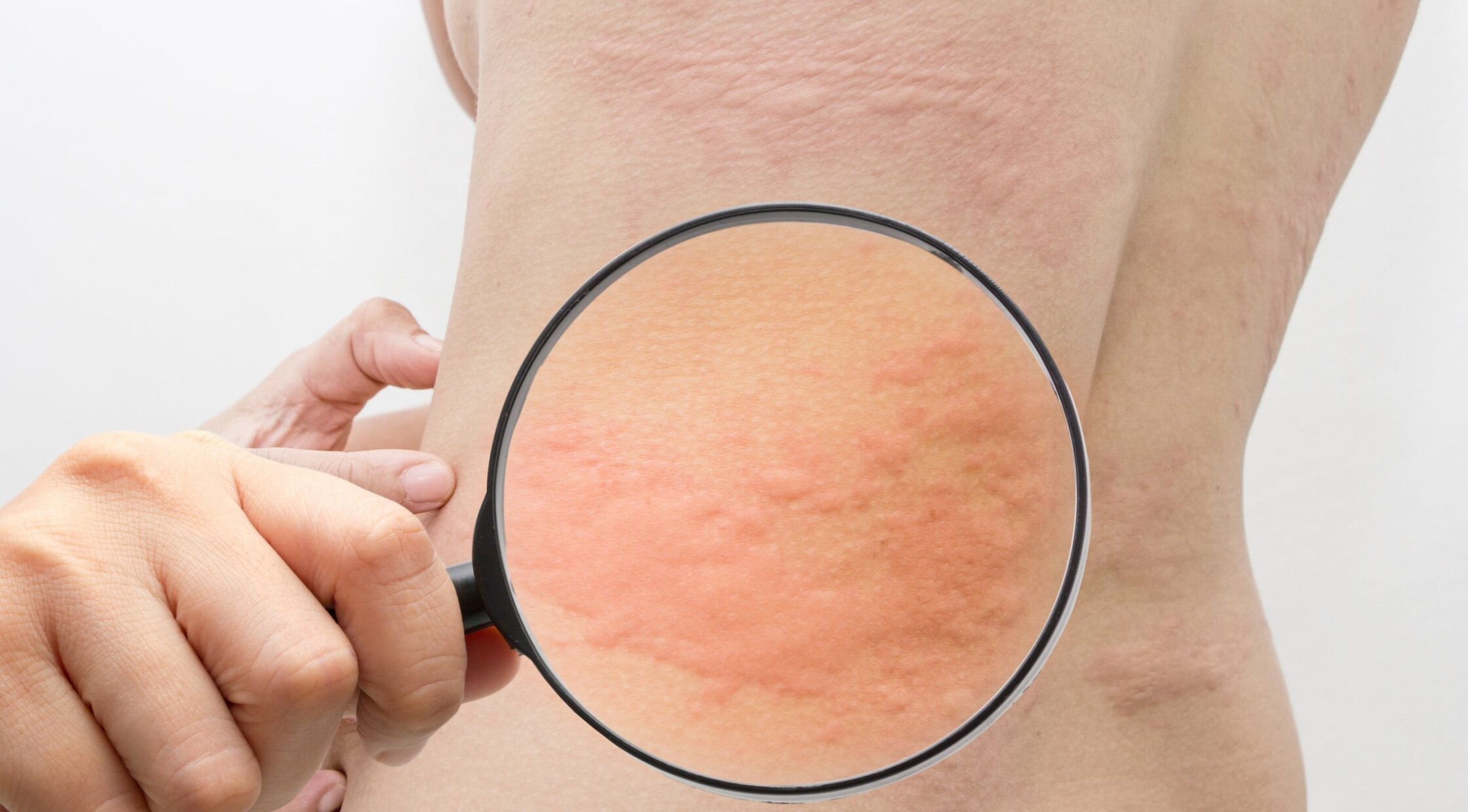 Що таке кропив’янка: симптоми, причини, лікування та все, що болить