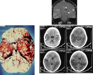 Чи виліковний енцефаліт: детальний розбір шансів на повне одужання