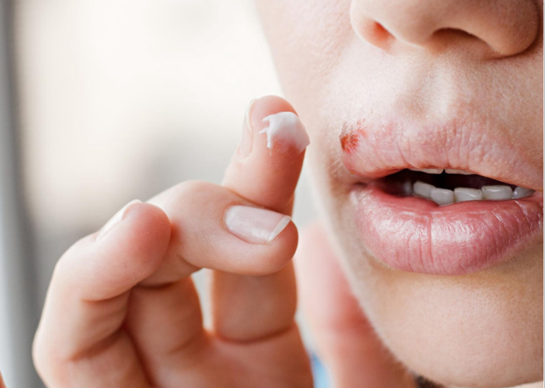 Чи передається герпес через поцілунок: повна правда про ризики та захист